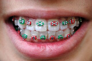 ortho-mouth-coloredbands